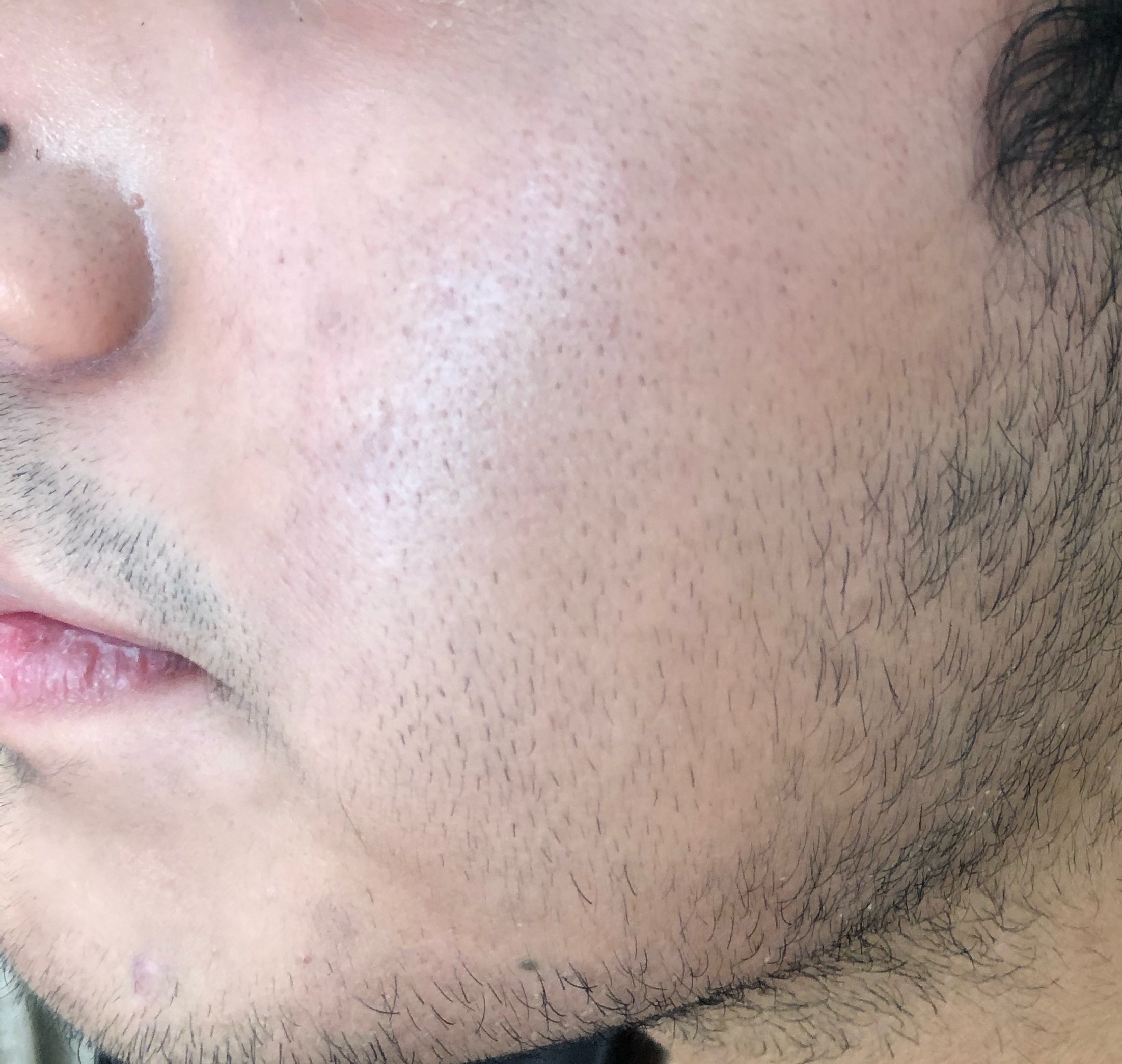 Casos de Acné - Antes y Después de Peelings